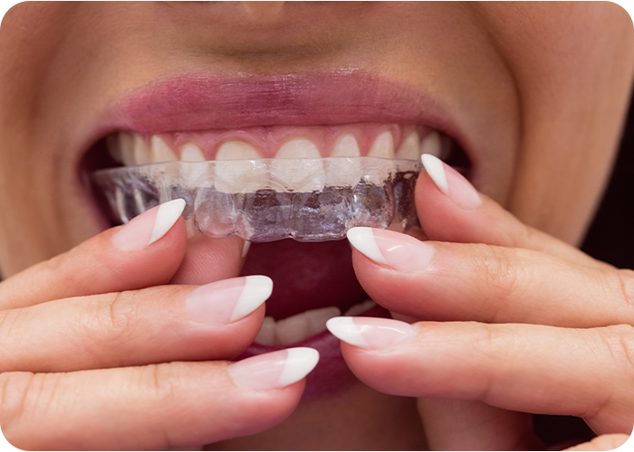 service 10 aligners doctor shahzeb patoli dentist in islamabad