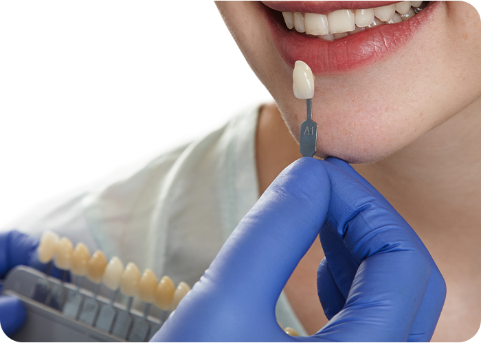 service 4 veeners doctor shahzeb patoli dentist in islamabad